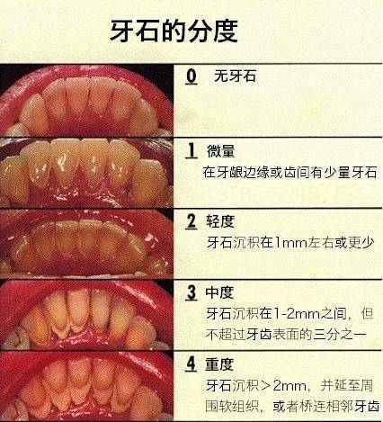 牙周炎 利尔·中国国际口腔连锁集团